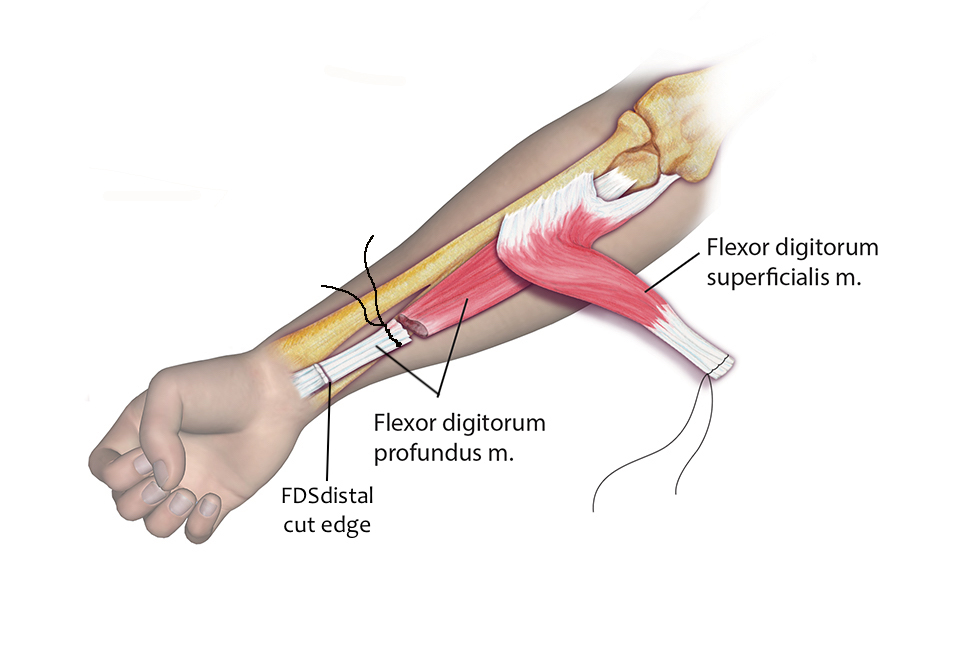 Cerebral Palsy Hand Surgery Resource